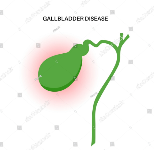 Gallbladder Surgery