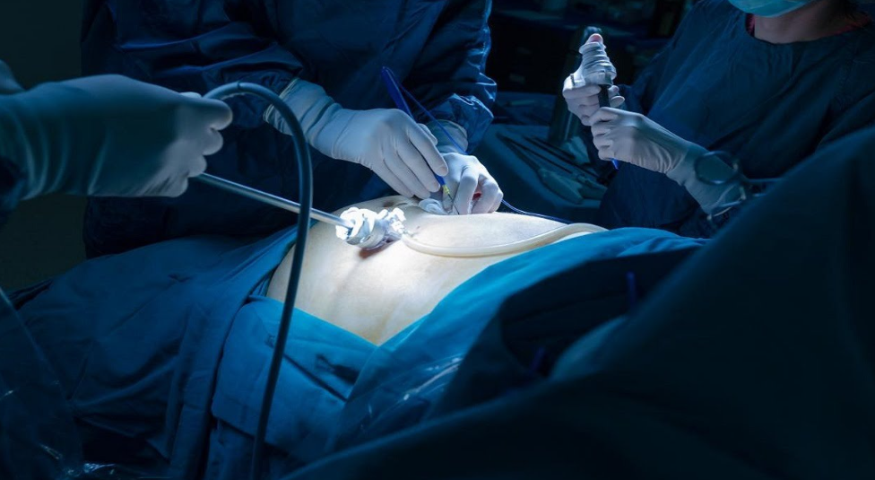 Laparoscopic Surgery